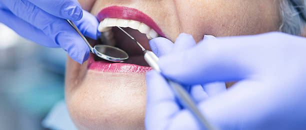 Best Emergency Wisdom Tooth Extraction in Hartford City, IN